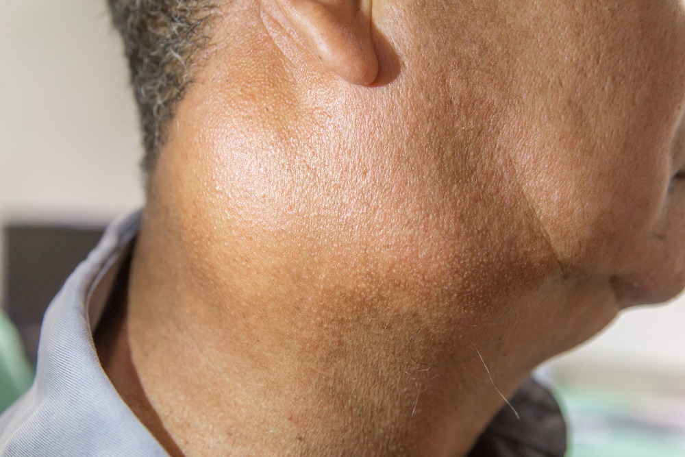 Zooming,Closeup,Lateral,View,Of,Enlarged,Lymph,Nodes,And,Submandibular
